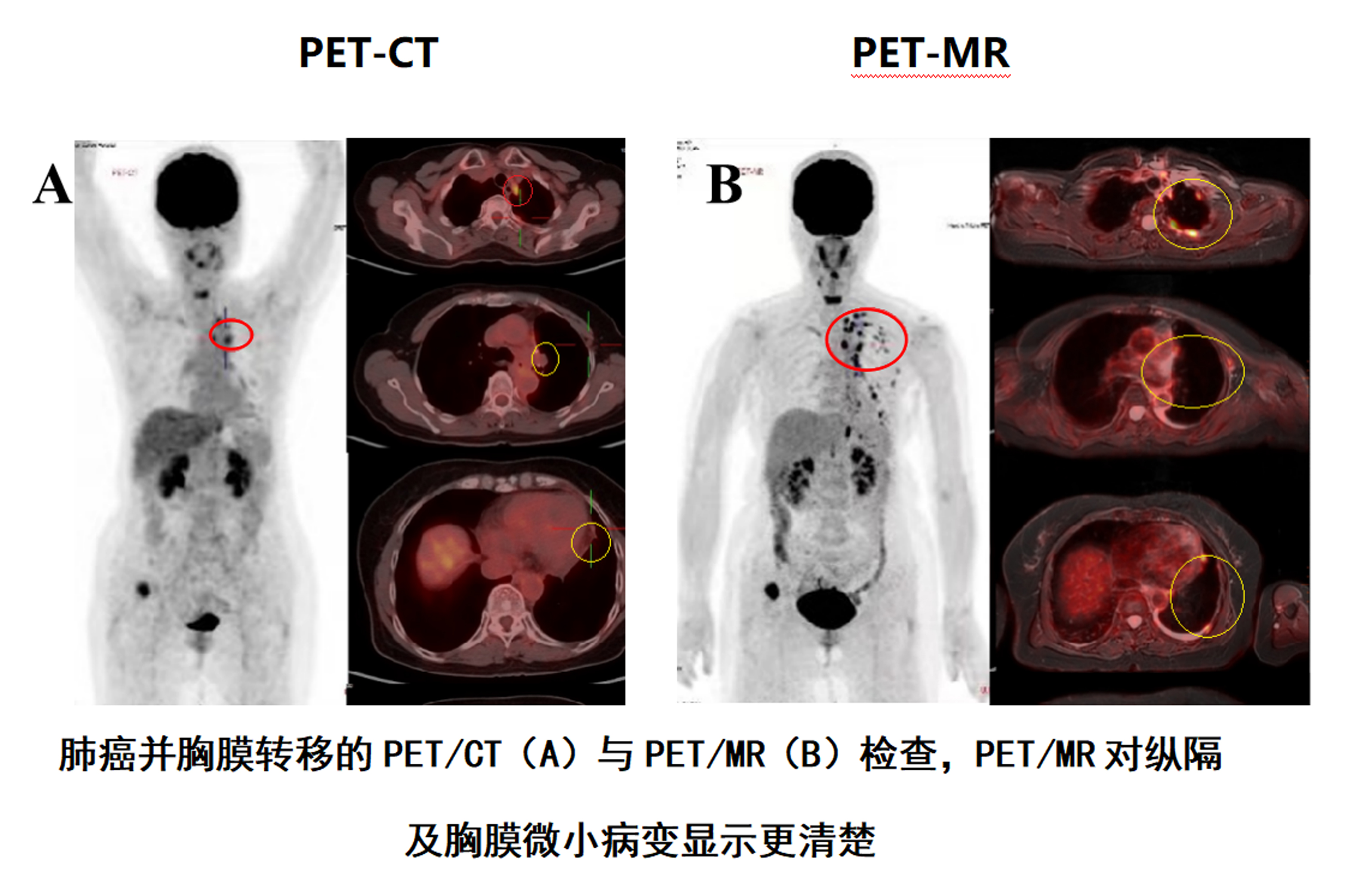 PET-CT和PET-MR对比